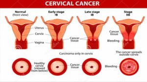 Cervical-Cancer-2006